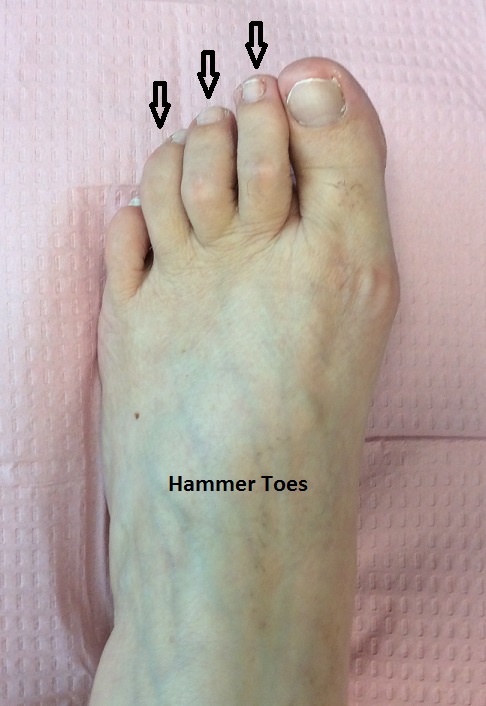 Hammer Toe