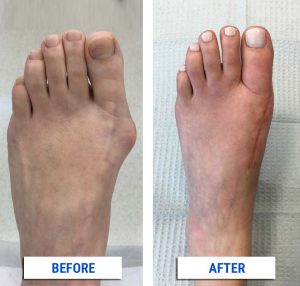 bunions-before-after-surgery